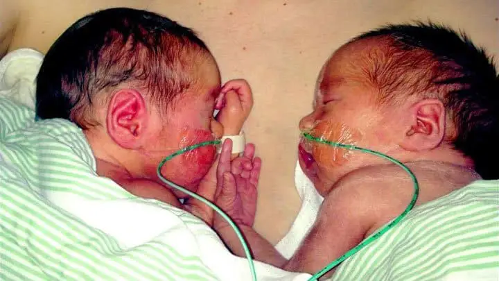 twins born at 34 weeks