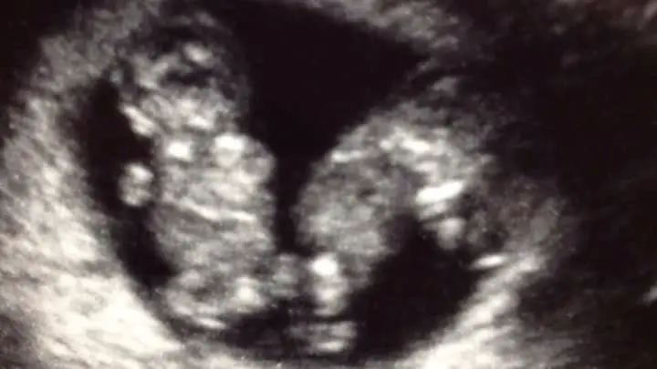 how early can a twin pregnancy be detected by ultrasound