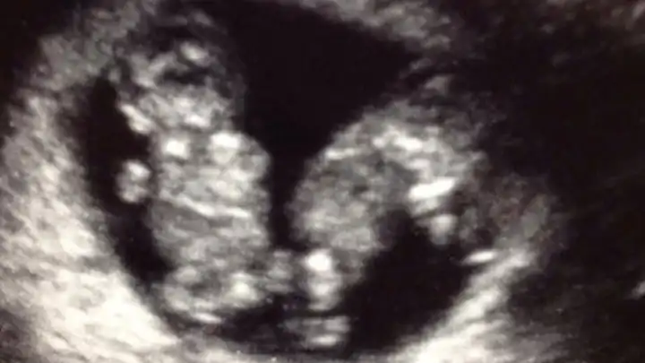 twin ultrasound