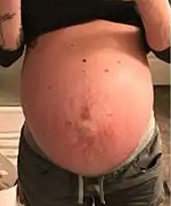 twin pregnancy belly