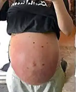 twin pregnancy belly