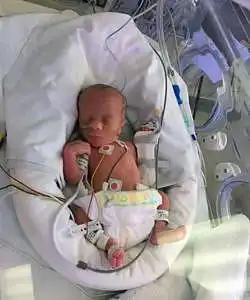 Identical twin born at 34+1 weeks