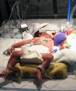 premature twin born at 31+0 weeks