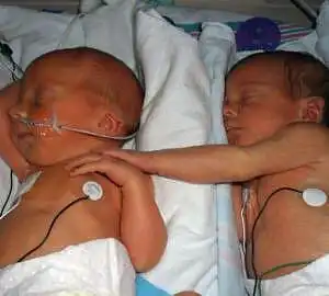 Twins Born at 34 Weeks: Labor and 