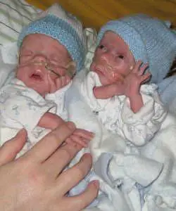 Twins Born at 28 weeks: Outlook And How to Cope - About Twins