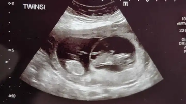 weeks ultrasound twin