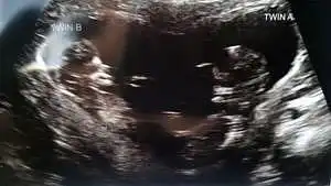 twin ultrasound 11 weeks