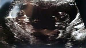 twin ultrasound 12 weeks