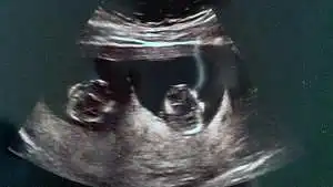 twin ultrasound 12 weeks