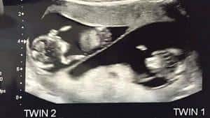 twin ultrasound 12 weeks