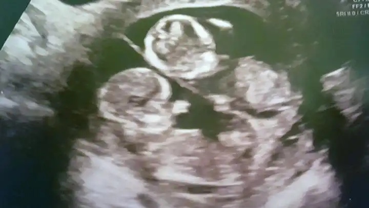 Twin Ultrasound 12 Weeks Dating And Chorionicity Scan About Twins