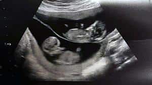 twin ultrasound 12 weeks