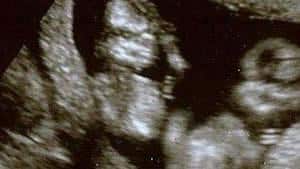 twin ultrasound 12 weeks