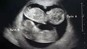 twin ultrasound 12 weeks