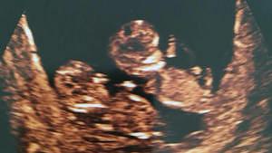 twin ultrasound 12 weeks