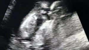 twin ultrasound 12 weeks