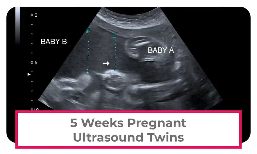 5 weeks pregnant with twins ultrasound. 