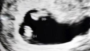 Twin ultrasound 7 weeks mo-di boys