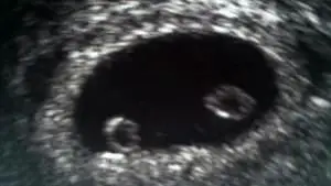 twin ultrasound 7 weeks girls