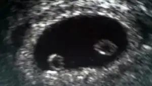 8 week ultrasound fraternal twins