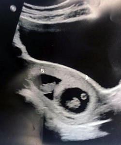 baby moving at 10 weeks ultrasound