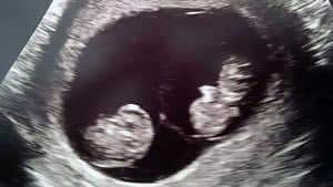 twin ultrasound 10 weeks
