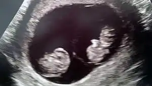 fraternal twins in the womb at 10 weeks