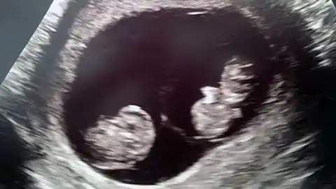 10 Weeks Pregnant With Twins: Symptoms, Belly & Ultrasound – About Twins