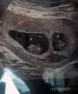 twin ultrasound 10 weeks