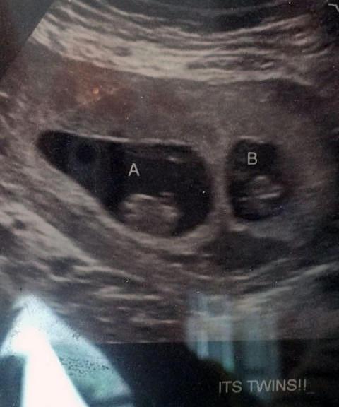 10 Weeks Pregnant With Twins Symptoms Belly And Ultrasound About Twins