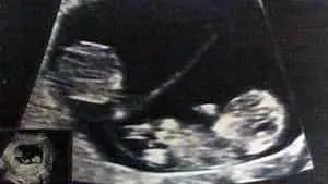 twin ultrasound 10 weeks
