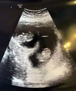 twin ultrasound 11 weeks