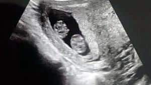 twin ultrasound 11 weeks