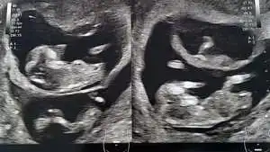 twin ultrasound 12 weeks