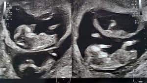 twins ultrasound 30 weeks