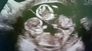 twin ultrasound 13 weeks