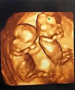 twin ultrasound 13 weeks