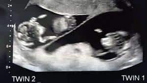 twin ultrasound 13 weeks