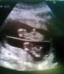 twin ultrasound 13 weeks