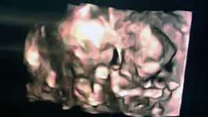twin ultrasound 14 weeks