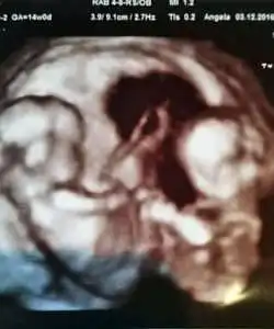 15 Weeks Pregnant With Twins Belly Pictures Ultrasound Symptoms About Twins