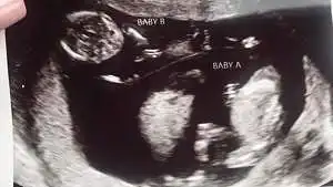 twin ultrasound 15 weeks