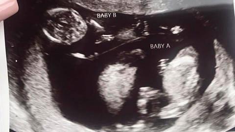 3d scan 15 weeks pregnant