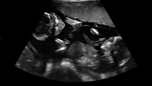 16 Weeks Pregnant With Twins: Symptoms, Belly & Ultrasound Pictures ...