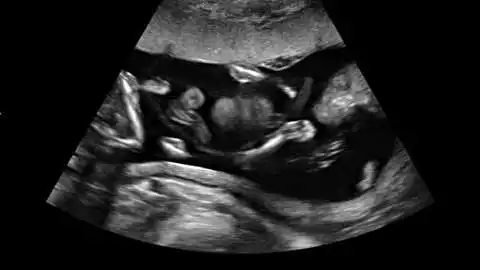 16 Weeks Pregnant With Twins: Symptoms, Belly & Ultrasound Pictures 