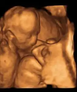 twin ultrasound 16 weeks