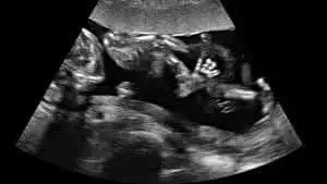 twin ultrasound 16 weeks