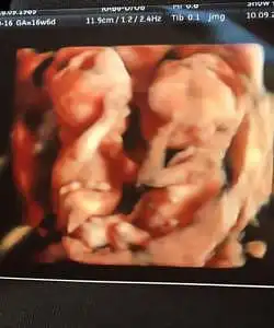 twin ultrasound 17 weeks