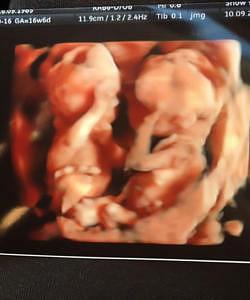 twin ultrasound 17 weeks