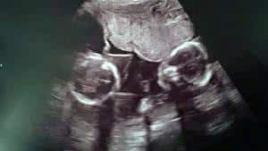 twin ultrasound 17 weeks